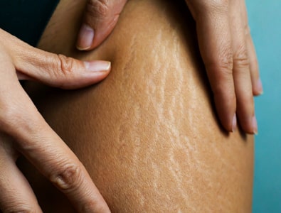 Stretch marks on inner thighs of women | Revive MD Inc in Barrie, ON