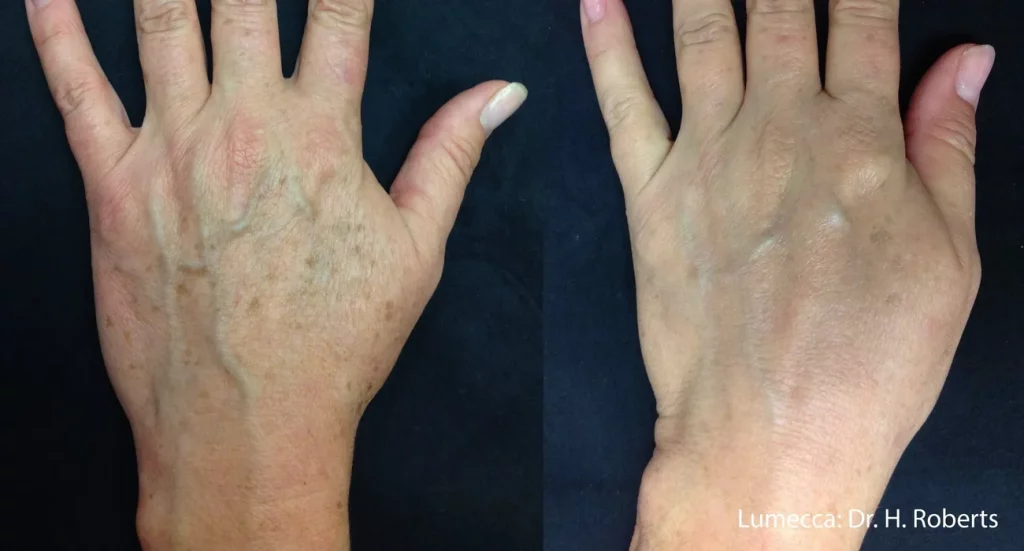 Results of Young Female hand with Lumecca Intensive-pulse-light treatment before and after | Revive MD Inc in Barrie, ON