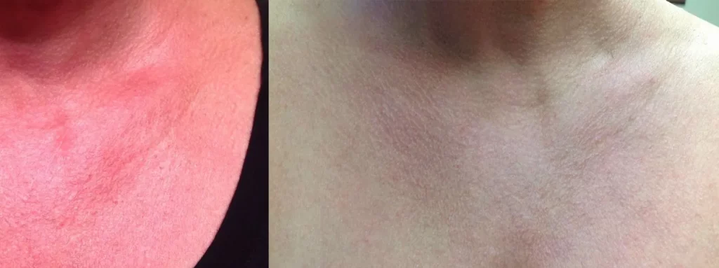 Results of Young Female with Lumecca Intensive-pulse-light treatment before and after | Revive MD Inc in Barrie, ON
