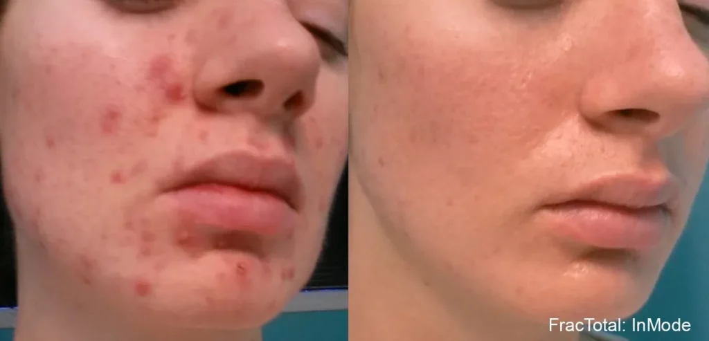Results of Young Female with Intensive pulse light treatment before and after | Revive MD Inc in Barrie, ON