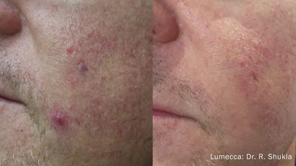 Results of Young Male with Lumecca Intensive-pulse-light treatment before and after | Revive MD Inc in Barrie, ON