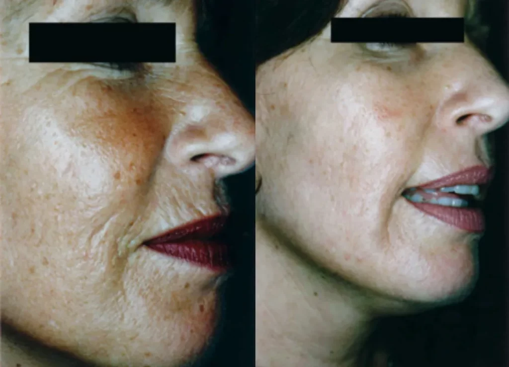 Microneedling Before and After Image | Revive Medspa in Barrie, ON