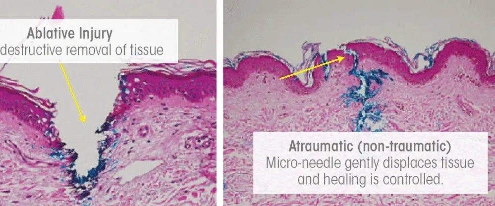 Ablative injury | Epidermis biopsy under microscope before and after Collagen Induction Therapy | Revive Medspa in Barrie, ON