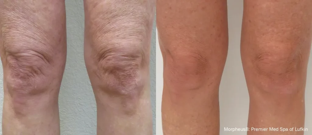 Before & After Morpheus8 treatment results on the knees | Revive MD Inc in Barrie, ON