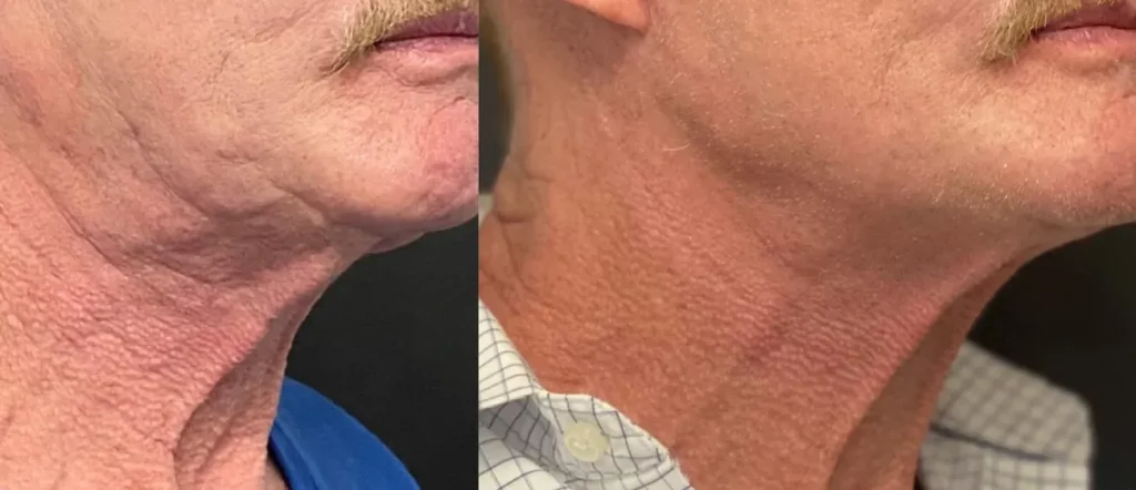 Before & After Morpheus8 treatment results of a man neck part | Revive MD Inc in Barrie, ON