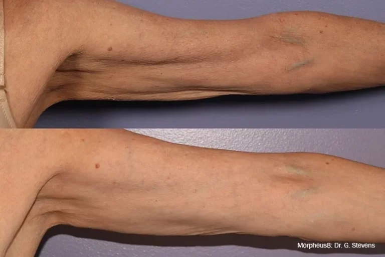 Before & After Morpheus8 treatment results on the arms | Revive MD Inc in Barrie, ON