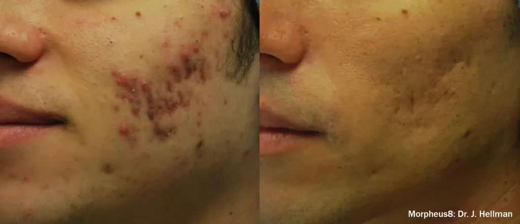 Before & After Morpheus8 treatment results on the cheeks | Revive MD Inc in Barrie, ON