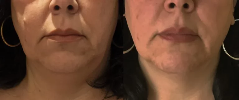 Before & After Morpheus8 treatment results of a woman | Revive MD Inc in Barrie, ON