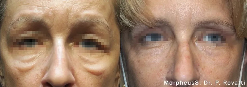 Before & After Morpheus8 treatment results of a woman | Revive MD Inc in Barrie, ON