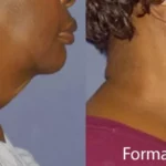 Beautiful senior woman Before and After Getting forma advanced radio frequency | Revive MD Inc in Barrie, ON