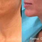 Beautiful woman Before and After Getting forma advanced radio frequency | Revive MD Inc in Barrie, ON