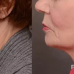 Beautiful senior woman Before and After Getting forma advanced radio frequency | Revive MD Inc in Barrie, ON