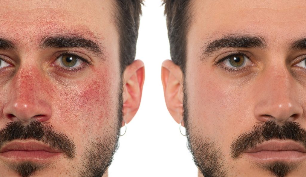 Male Rosacea Before and After Treatment | Revive MD Inc in Barrie, ON