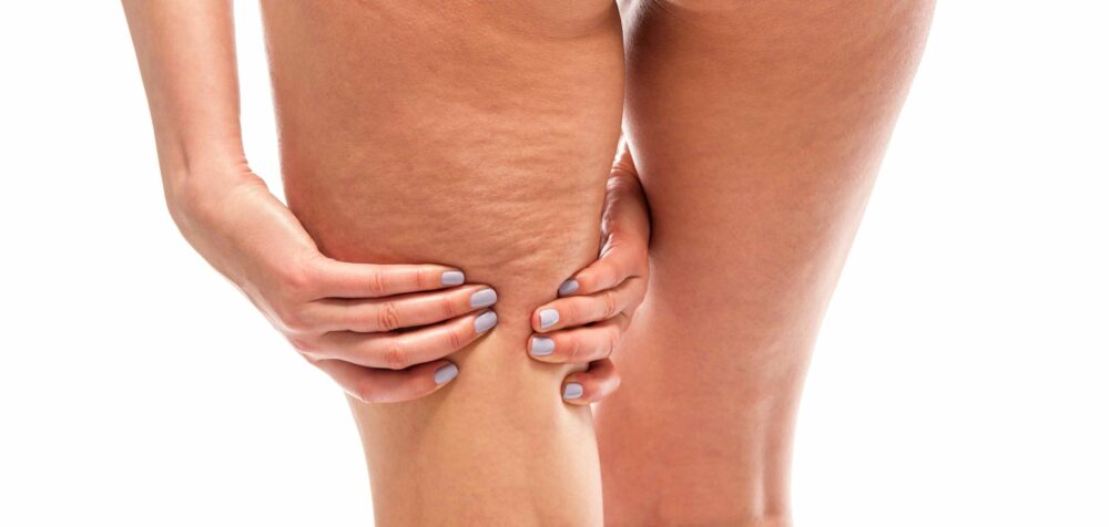 A Woman Touches Her Thick Cellulite Thighs with Her Hands | Revive MD Inc in Barrie, ON
