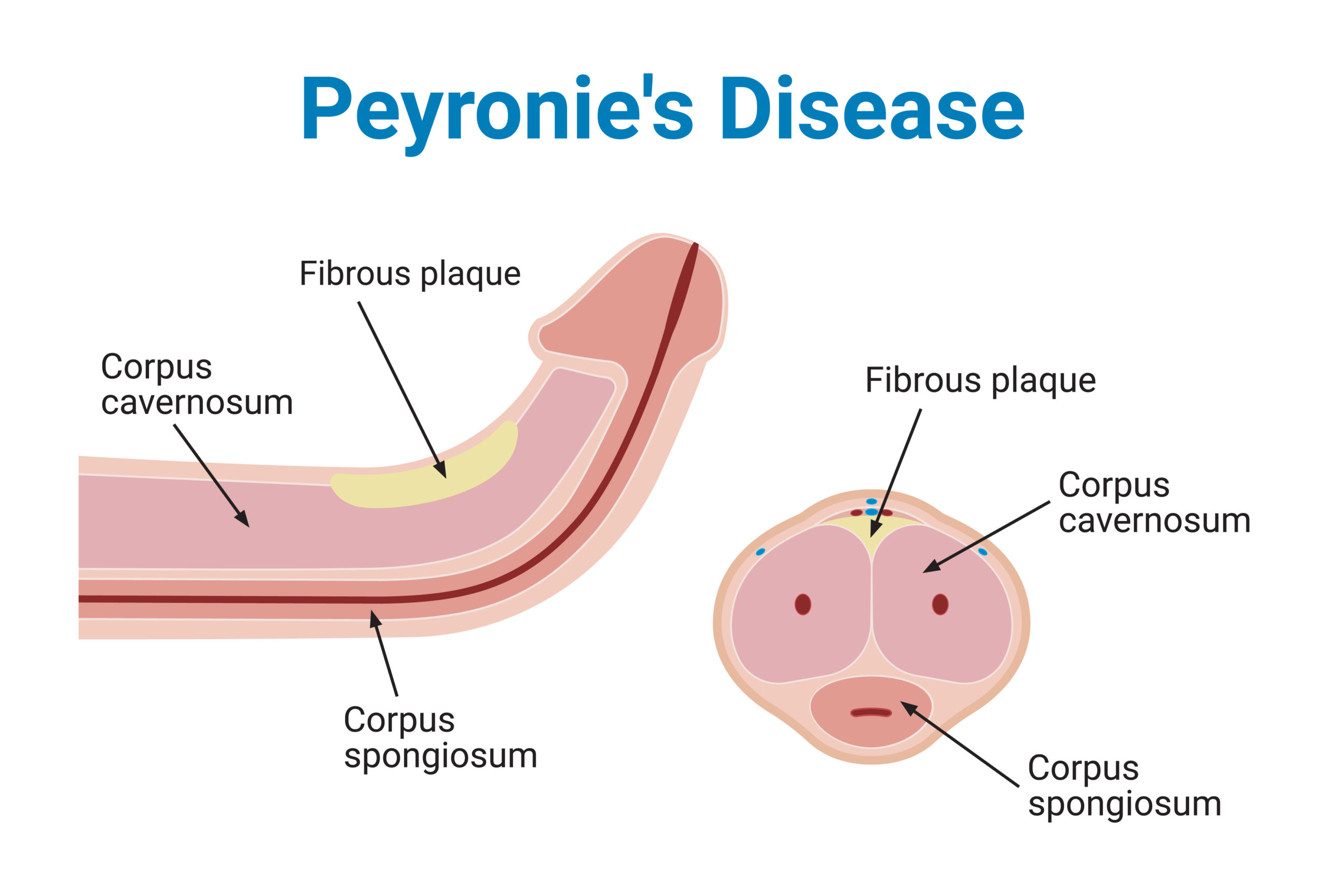 Understanding Peyronie's Disease Symptoms, Causes, and Treatment Options