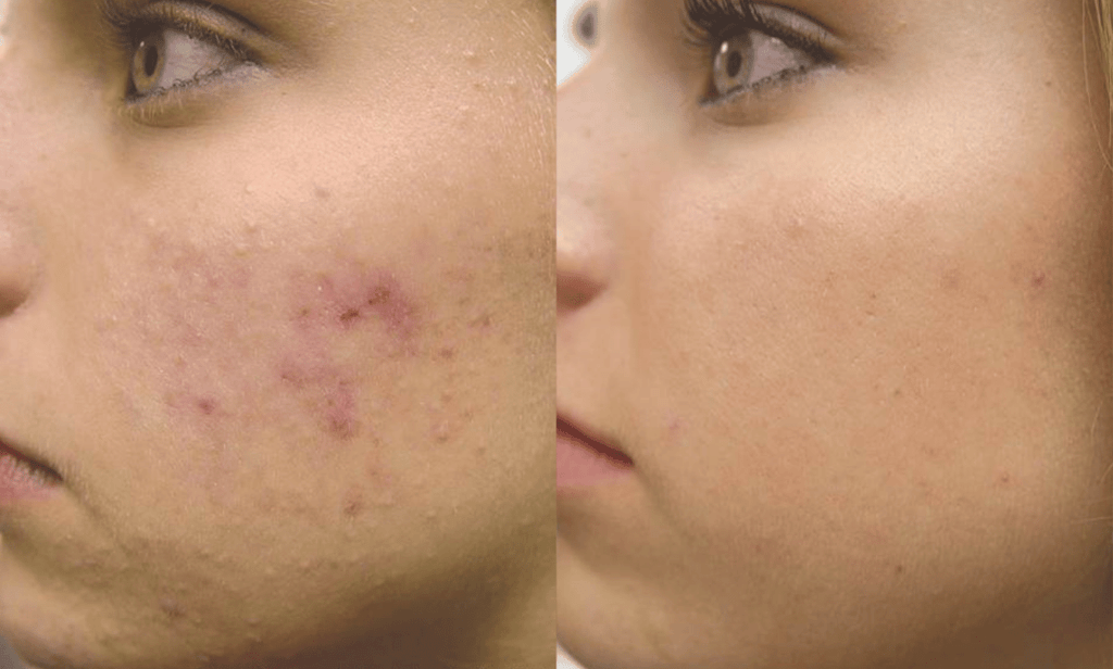 Acne Treatment Before and After Before and after comparison of acne and acne-related skin concerns