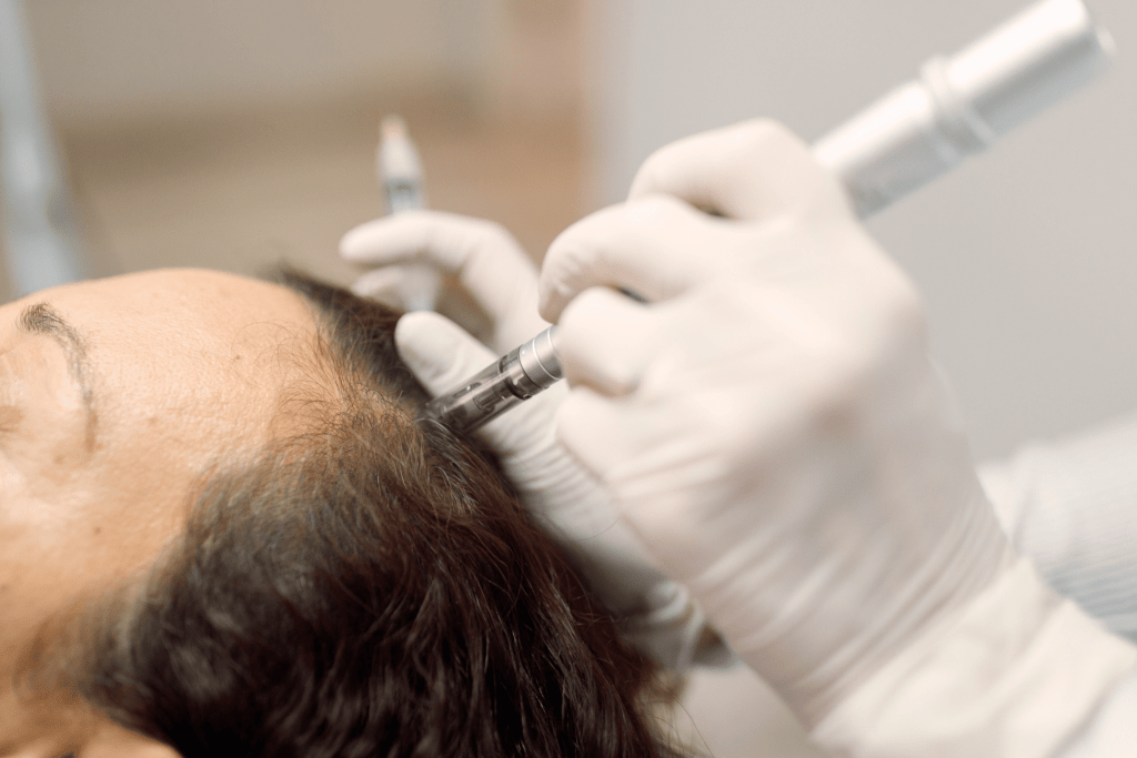 Microneedling Hair Loss Treatment Near Me | Boost Hair Growth with Microneedling