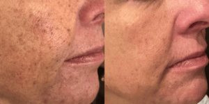 Lumecca IPL Treatment Barrie Before and After