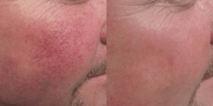 Lumecca IPL Treatment Barrie Before and After