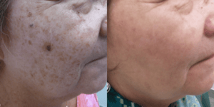 Lumecca IPL Treatment Barrie Before and After