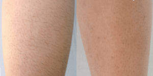 significant hair reduction and smoother skin