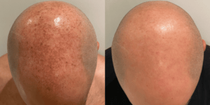 Lumecca IPL Treatment Barrie Before and After