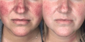 Lumecca IPL Treatment Barrie Before and After