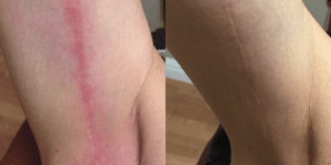 Lumecca IPL Treatment Barrie Before and After