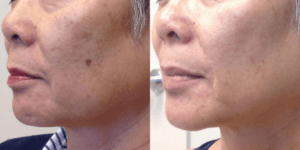 Lumecca IPL Treatment Barrie Before and After