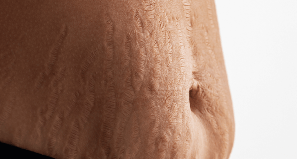 Treatment for stretch marks at Revive Medical Aesthetics & Spa in Barrie, aiming to reduce the appearance of stretch marks