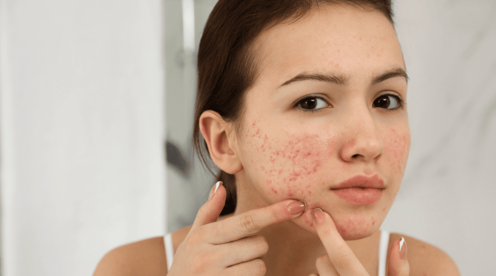 Morpheus8 treatment for active acne at Revive Med Spa in Barrie, Ontario, offering clear skin solutions with microneedling and radiofrequency technology