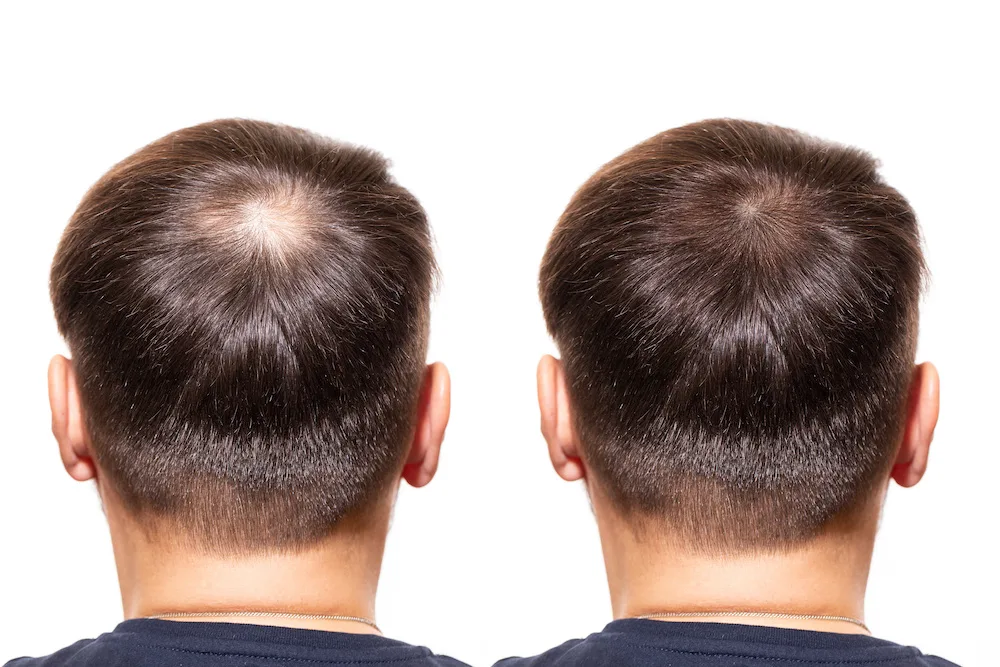 How-Does-Platelet-Rich-Plasma-Therapy-PRP-Work-for-Hair-Loss-2